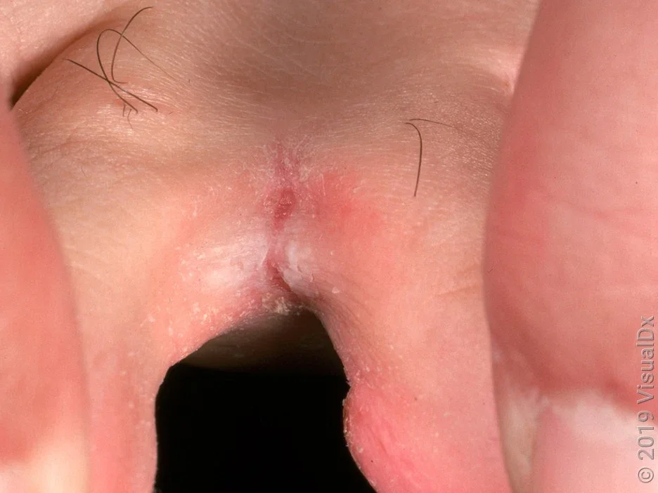 Athlete’s foot can cause white patches and peeling between toes. 