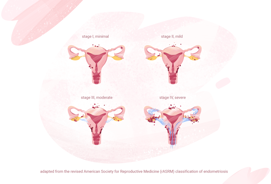 Uterus diagrams showing the four stages of endometriosis: Stage I minimal, Stage II mild, Stage III moderate, Stage IV severe.