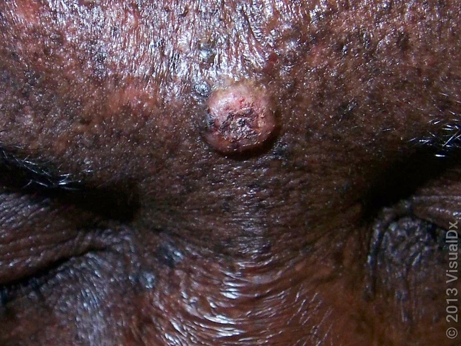 Close-up of a squamous cell carcinoma on Black skin. 