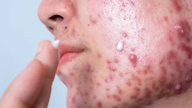 Spironolactone vs. Tretinoin for Acne: 5 Differences to Consider