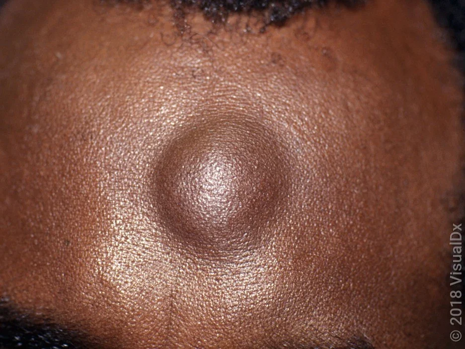 Close-up of a forehead lipoma. 