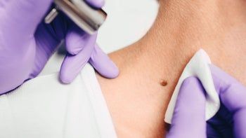 Health: Dermatology: close up mole scan 1130732676