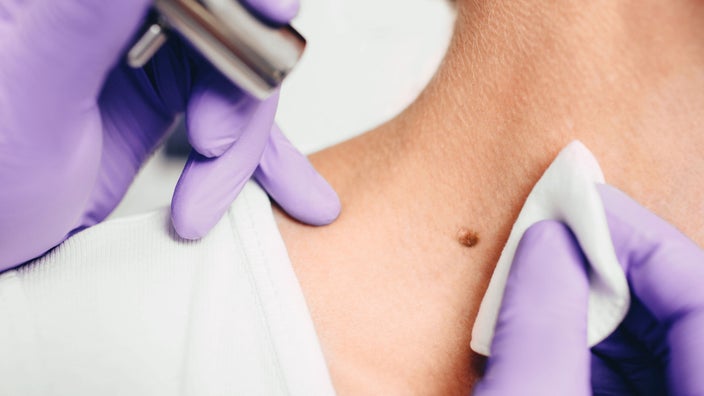 How Much Does Mole Removal Cost? Excision and Laser Prices - GoodRx