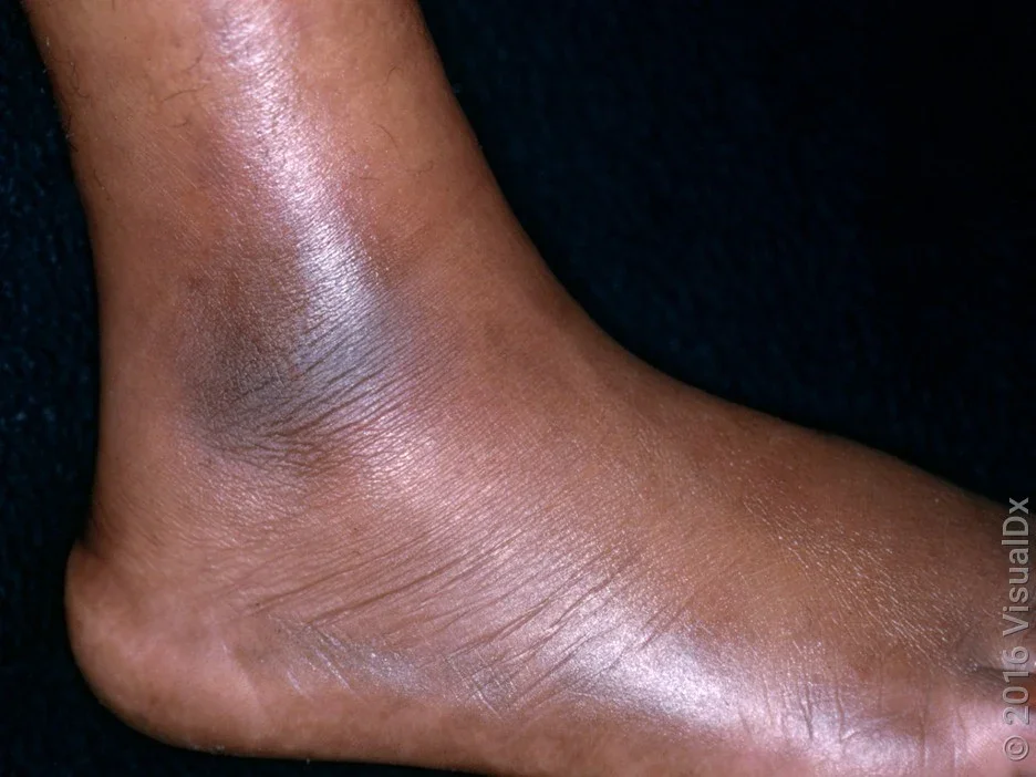 Close-up of erythema nodosum on the ankle.  