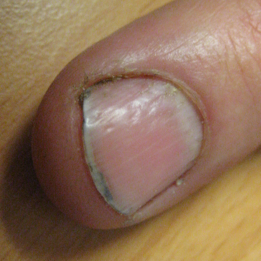 Psoriatic Arthritis Nail Symptoms: 6 Common Signs - GoodRx Psoriatic Arthritis Nail Symptoms: 6 Common Signs - GoodRx