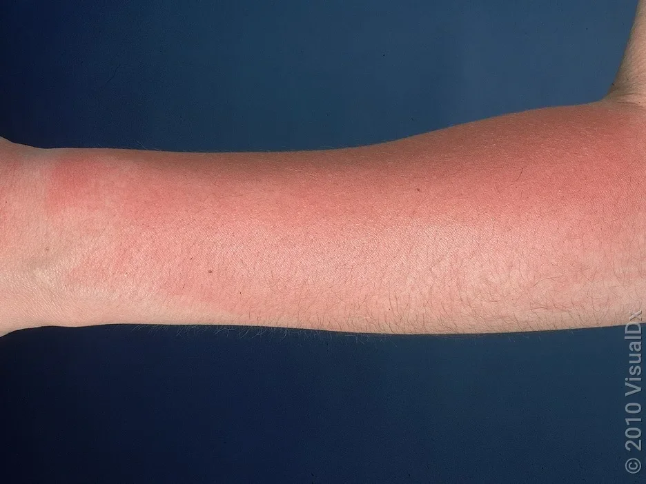 Sunburn on the forearm.