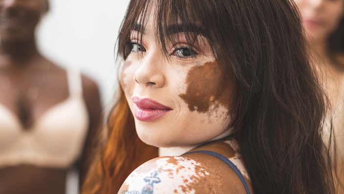 Vitiligo