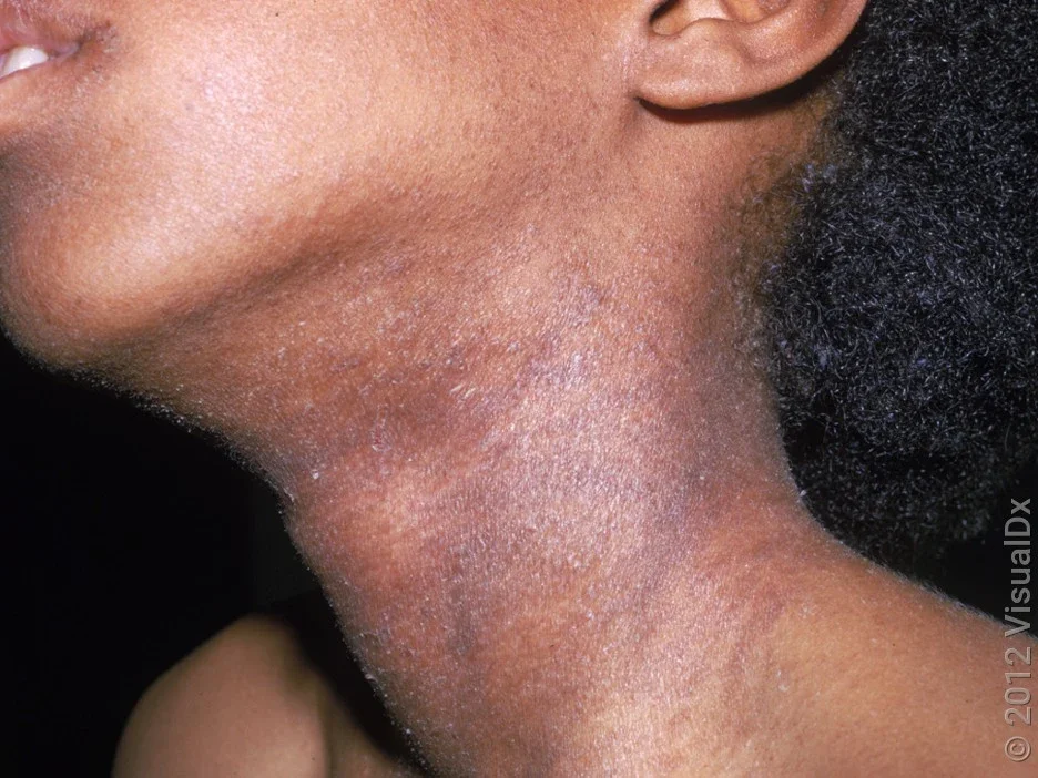 Close-up of eczema on the neck of a person with darker skin tone.