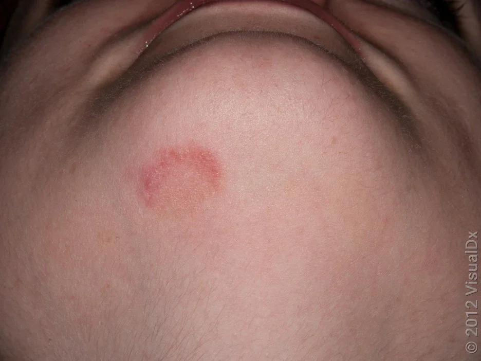Close-up of ringworm on the face. 