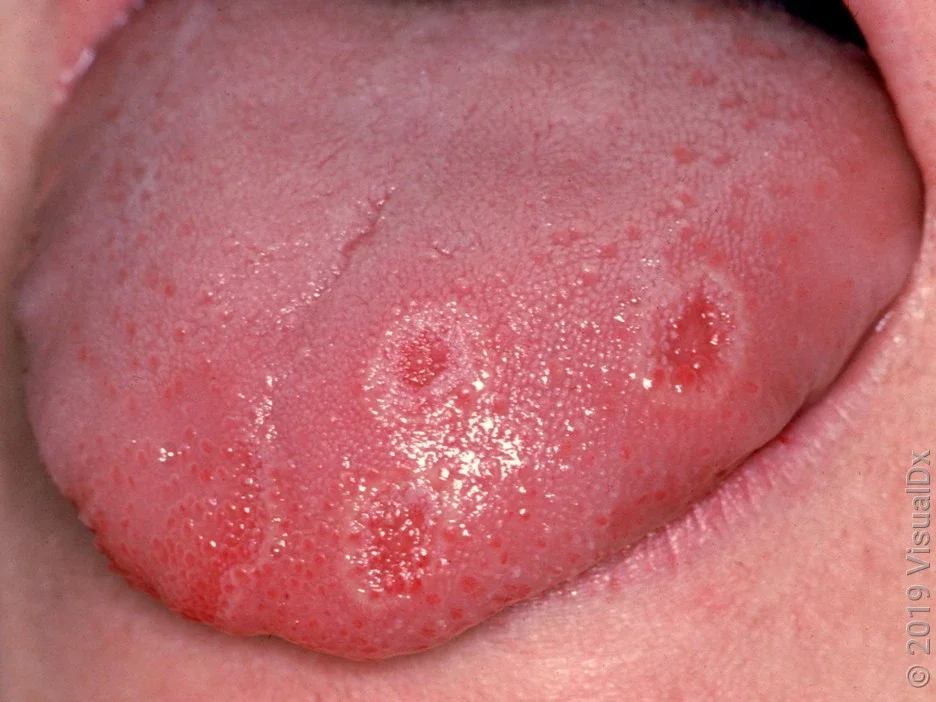 Close-up of three canker sores on the tongue. 