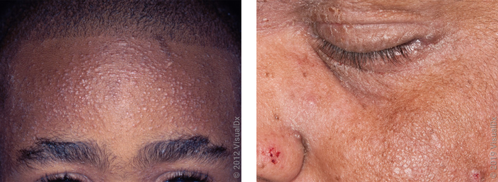 Left: Close-up of a forehead with many tiny violet and skin-colored bumps in eczema. Right: Close-up of a face with flaking around the eyelid and pink skin bumps on the cheek (eczema).