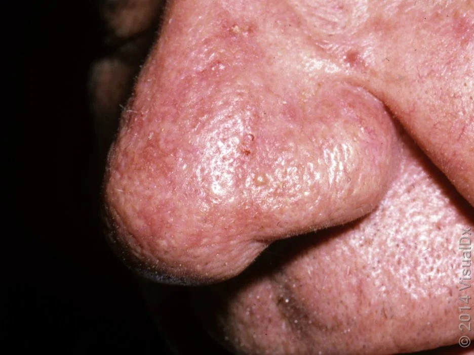 Close-up of nose with rosacea skin thickening.