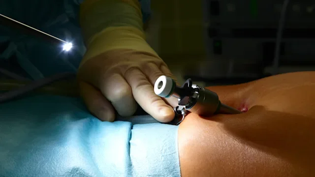 Health: Procedures: laproscopic surgery-157581871