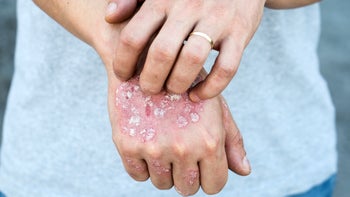plaque psoriasis: closeup hand with psoriasis 849442822