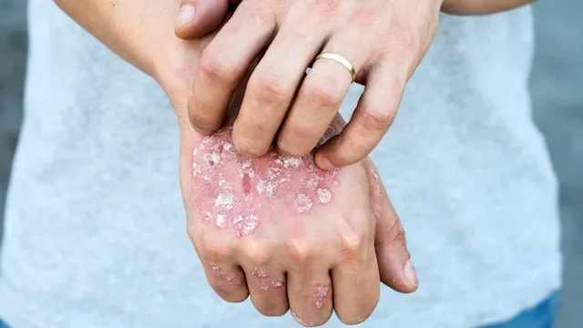 Sotyktu vs. Cosentyx for Plaque Psoriasis: 6 Differences You Should Know