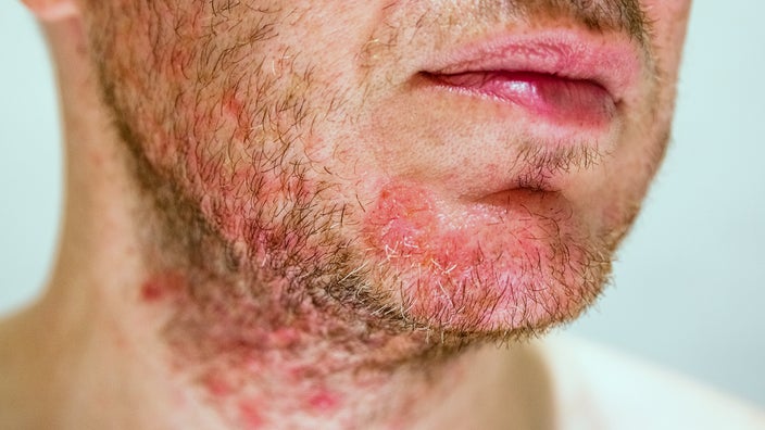 A cropped shot of severe eczema on a man's face.