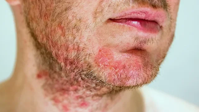 Eczema: face eczema 1031985760
