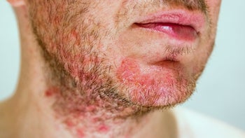 Eczema: face eczema 1031985760