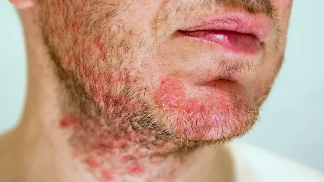 Eczema: face eczema 1031985760