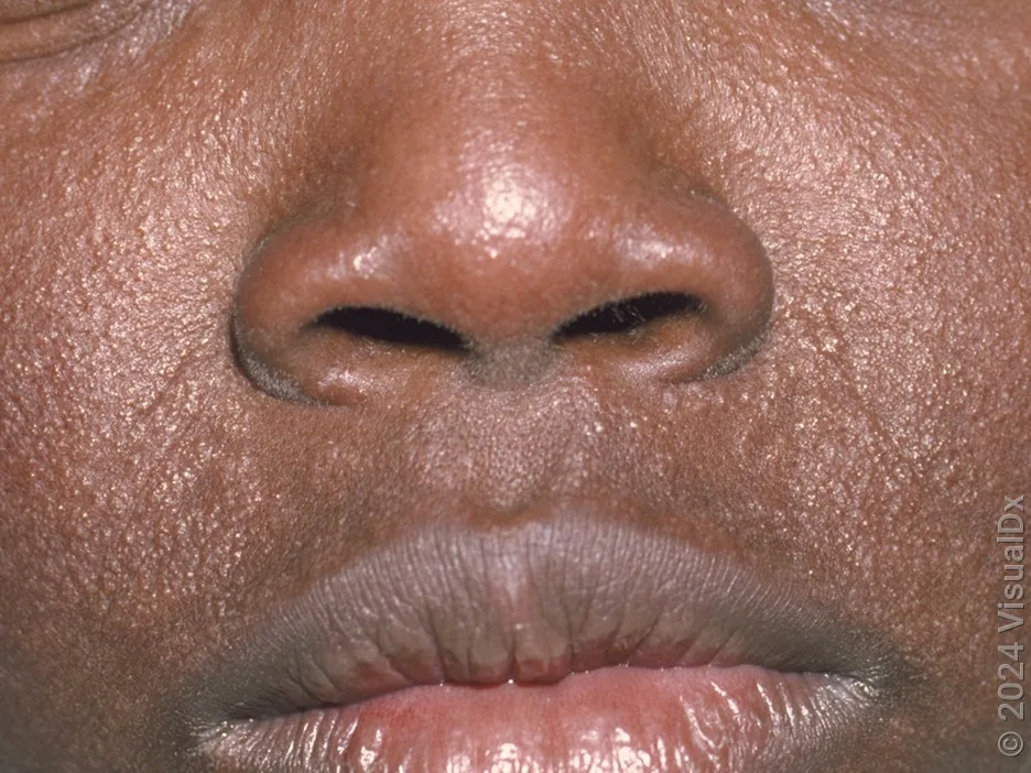 Close-up of facial eczema on the skin of a Black man. 
