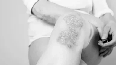 Black and white close-up of psoriasis on a person’s knees.
Natalia SERDYUK/iStock via Getty Images