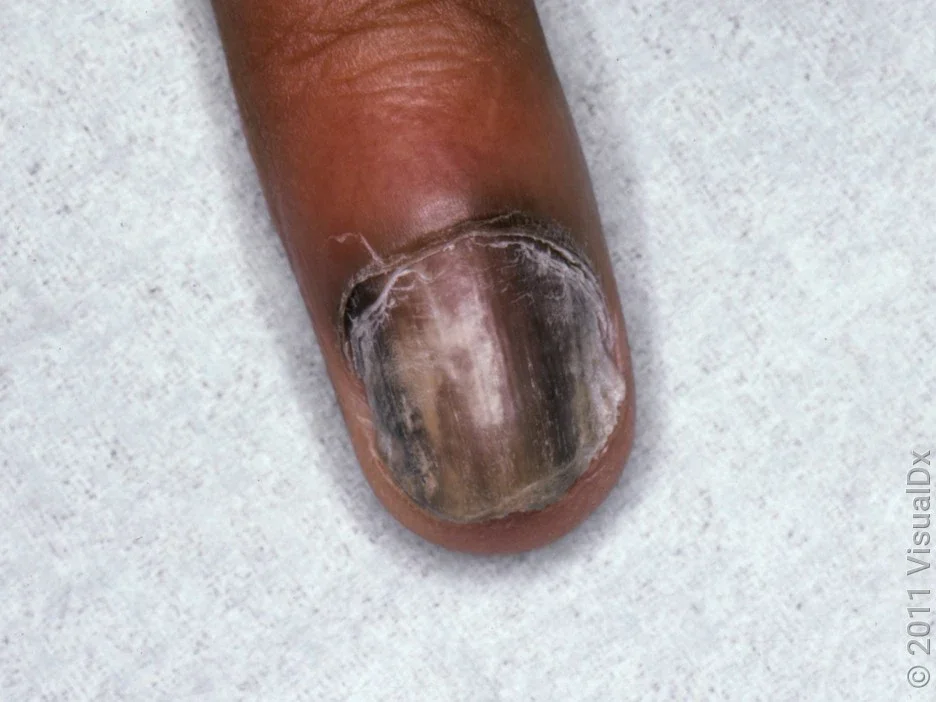 Close-up of a subungual hematoma that involves the entire nail.