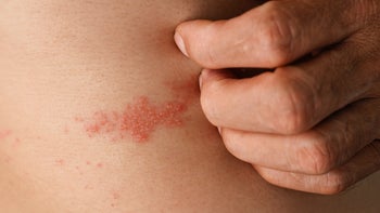 Dermatology: closeup scratching shingles rash 1557538545