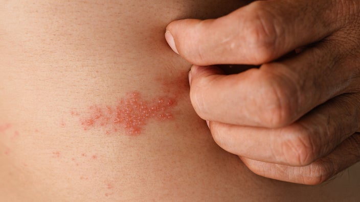 A person scratches a shingles rash.