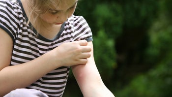 young girl with bug bit 172924089