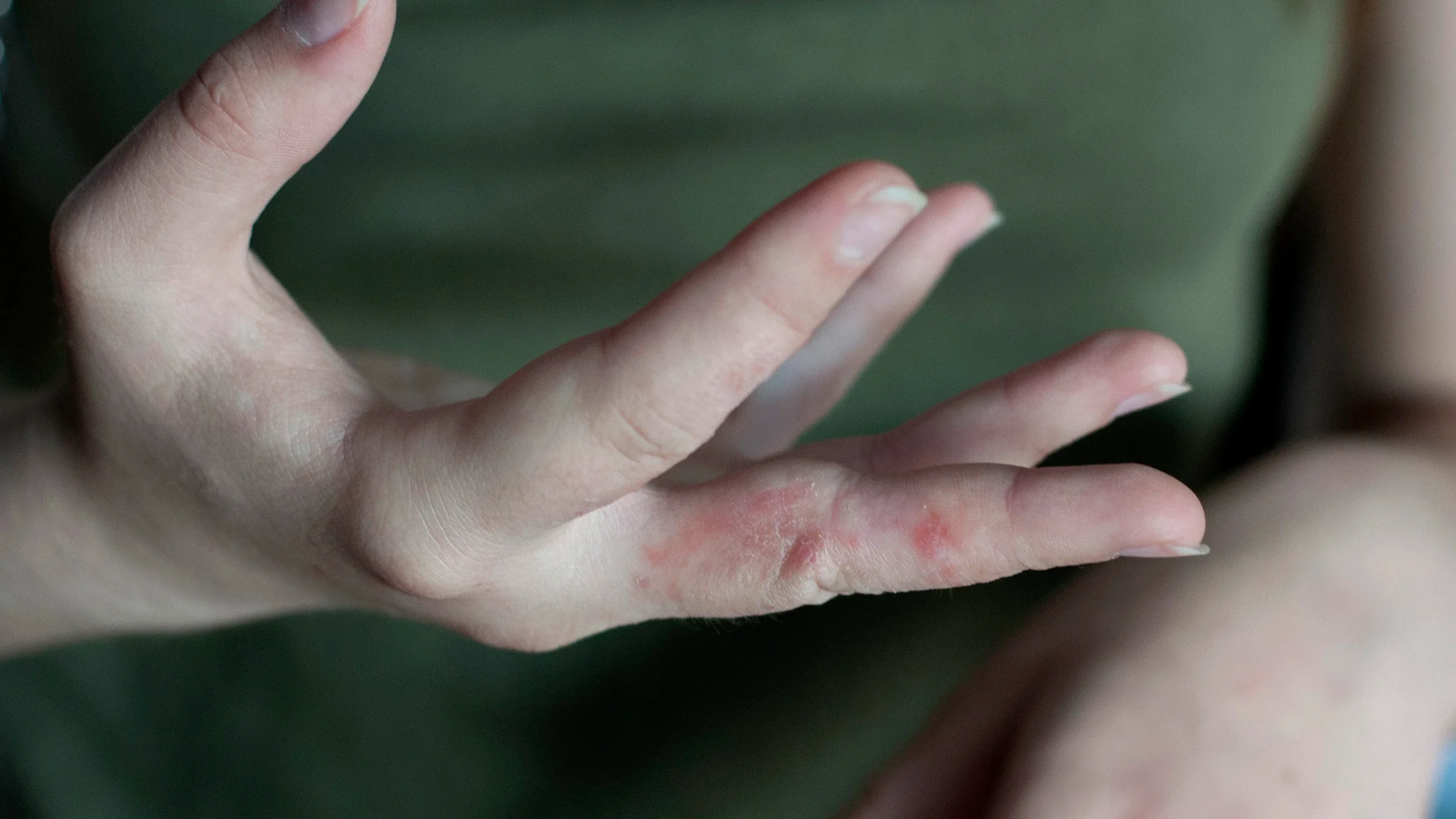A person has eczema on the inner side of the finger. At first glance, a skin infection may appear as eczema. Learning to spot the differences is key to treatment. 