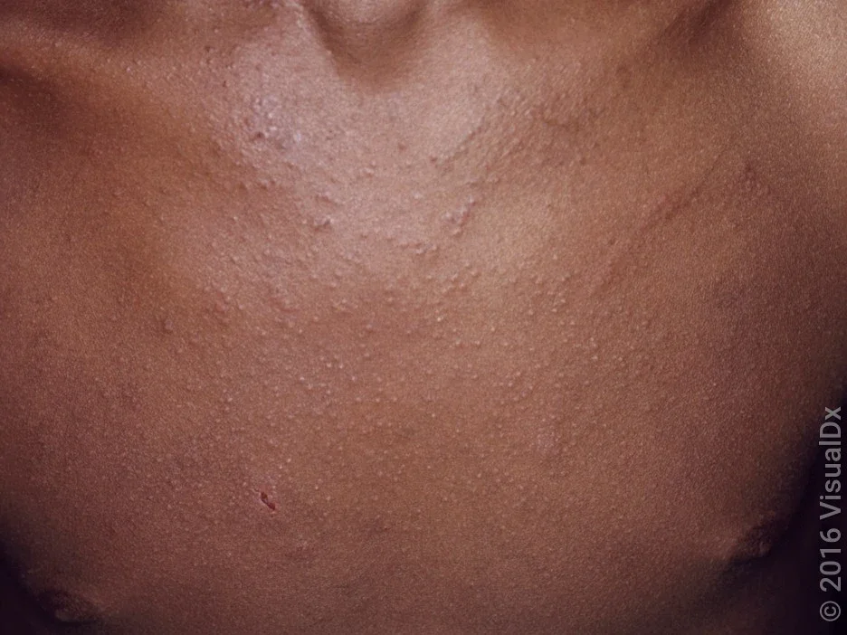 A chest with many tiny, light brown skin papules.