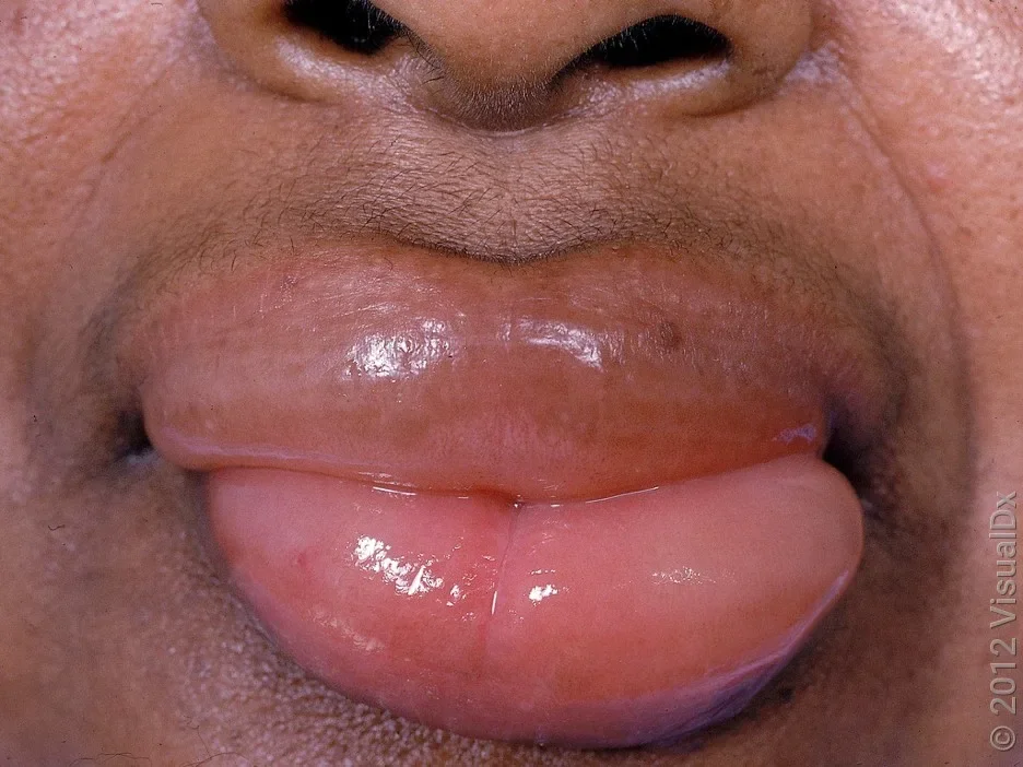 Angioedema of the lips.