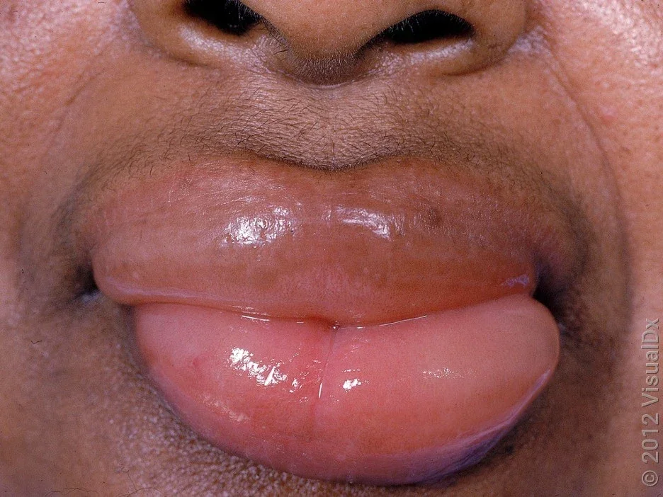 Angioedema of the lips. 
