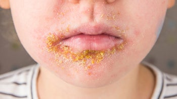 Health: Skin Infection: GettyImages 1204003540