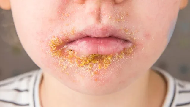 What Is Impetigo? Symptoms, Treatment, and Pictures
