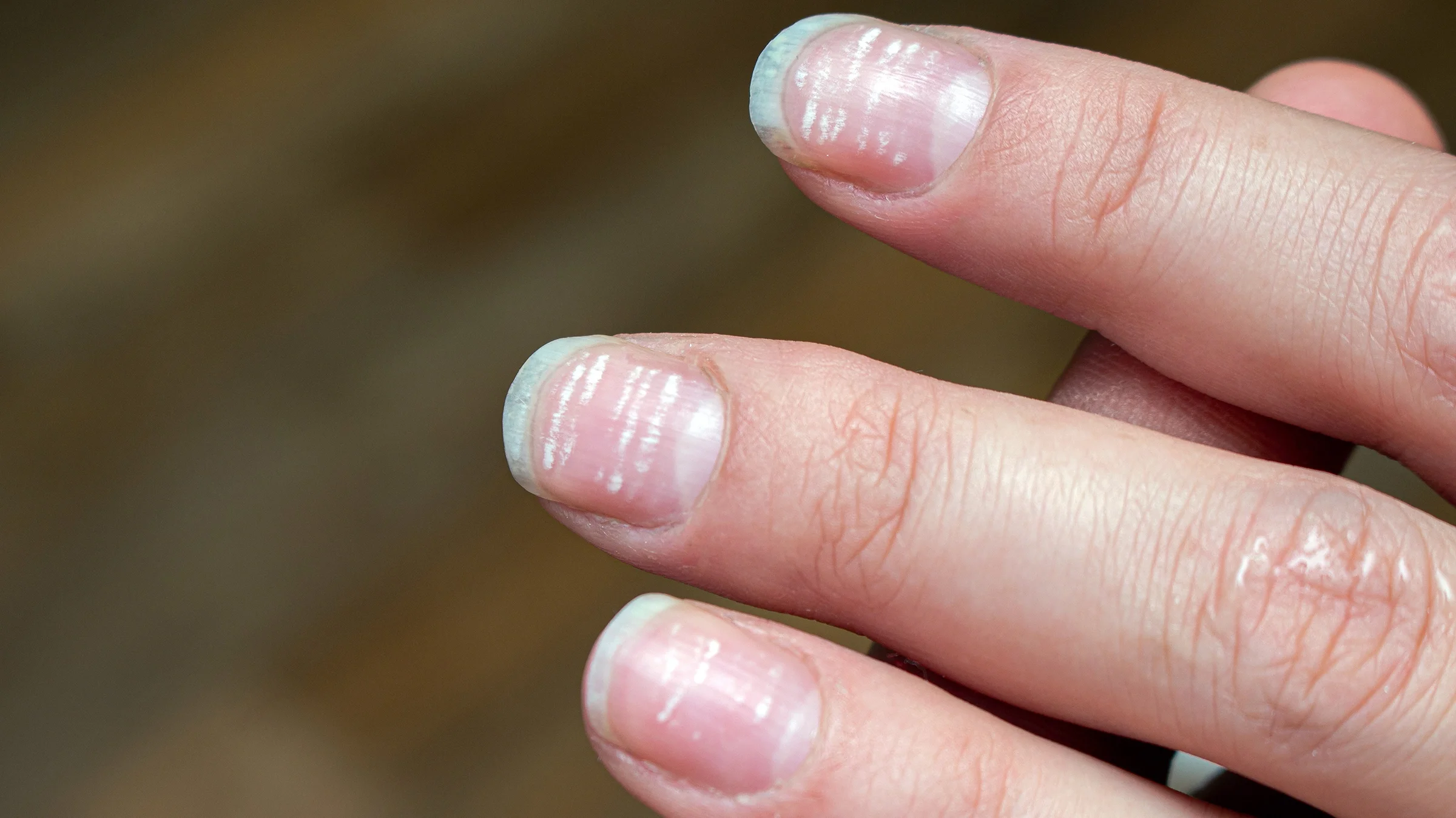 A close-up on a person's finger nails with white lines and spots.