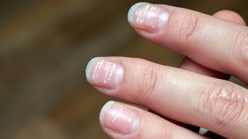 dermatology: nail damage white lines-1277450093