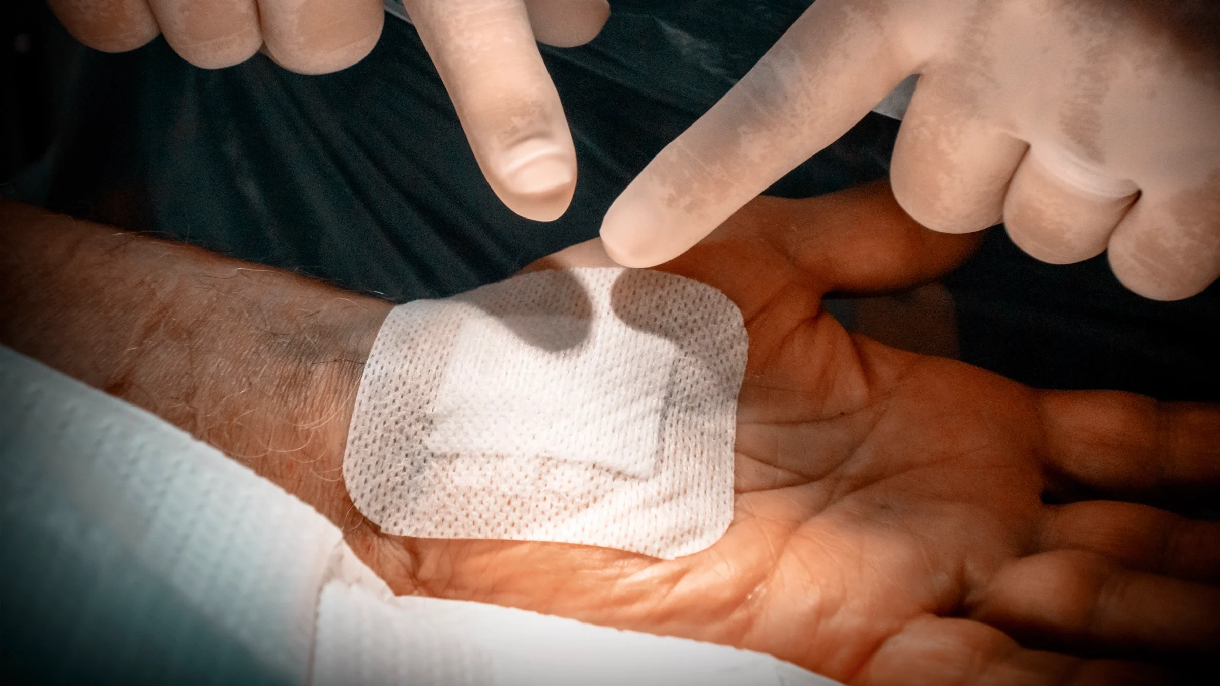 A person’s wrist is bandaged after carpal tunnel surgery, a procedure that relieves pressure on the nerve and can help reduce symptoms of carpal tunnel syndrome like tingling and numbness.