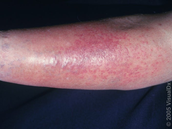 Mild swelling and a red rash (stasis dermatitis) on the shin of a person with stasis dermatitis. 