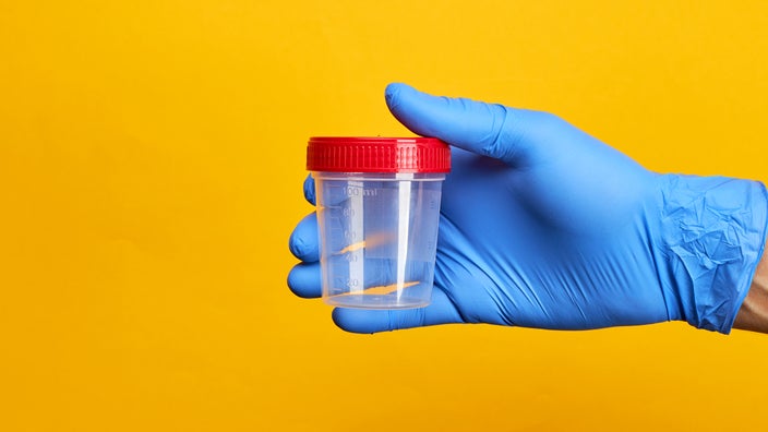 A person holds a specimen cup. Testing stool samples can help healthcare providers diagnose different conditions. Collecting a stool sample at home can be a daunting task, but you can do it in five easy steps. Learn more in this article. 