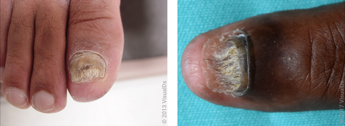 Left: A thickened and misshapen toenail. Right: Close-up of a broken and misshapen nail. 