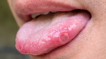 Health: Herpes: tongue sore-956084414