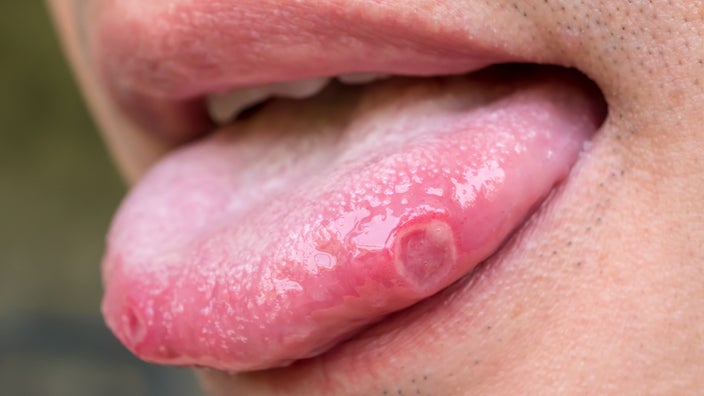 A cropped close-up of a person's tongue sticking out to show the side of it with a sore on it.