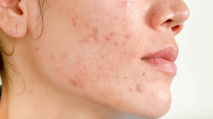 white acne scars on face