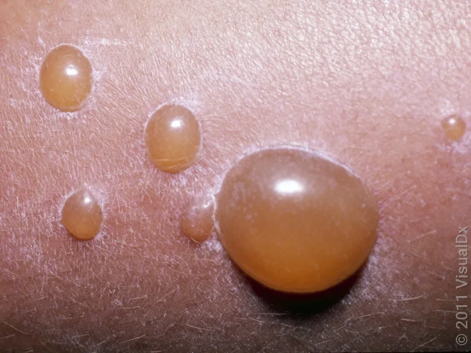 Close-up of bullous impetigo. 