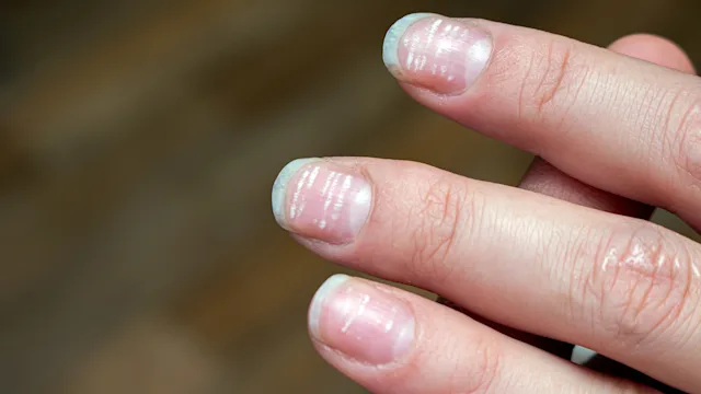 Dermatology: closeup nails with horizontal lines 1277450093