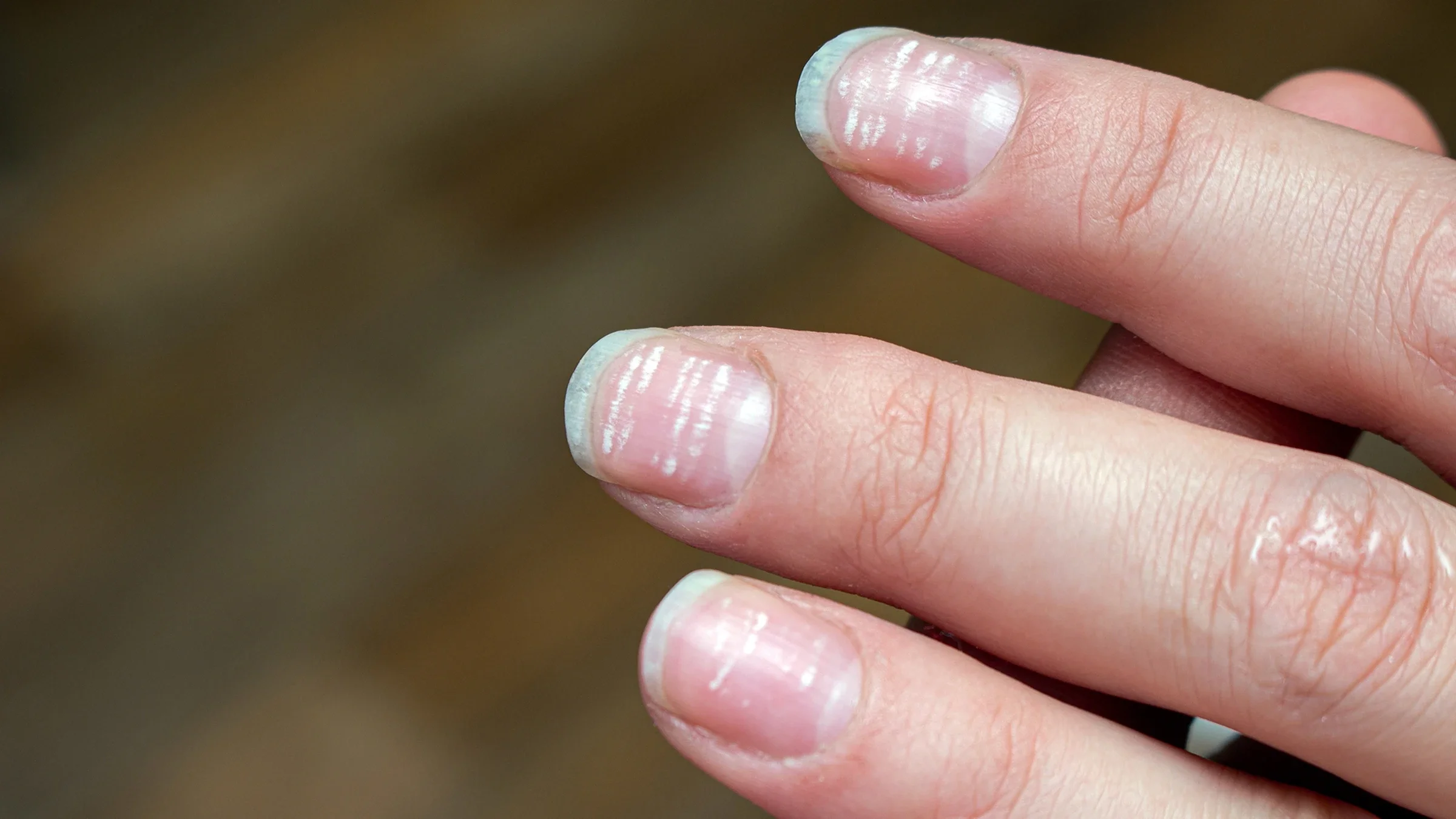 White horizontal lines appear on fingernails.