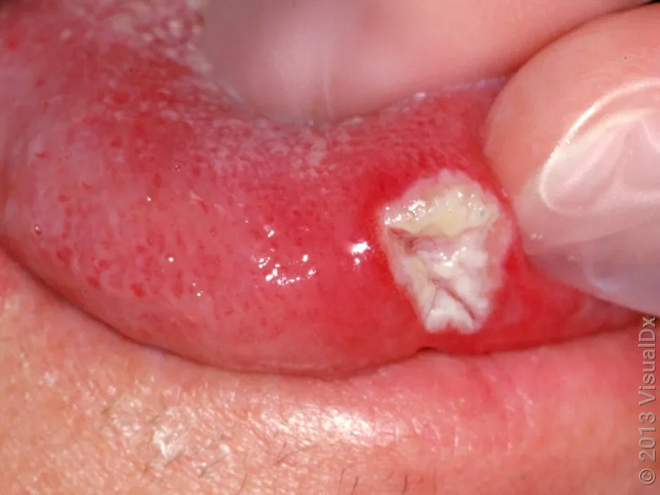Close-up of a canker sore on the tongue.