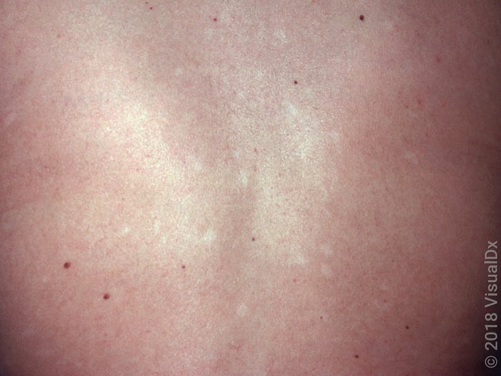 Close-up of the back with post-inflammatory hypopigmentation. 