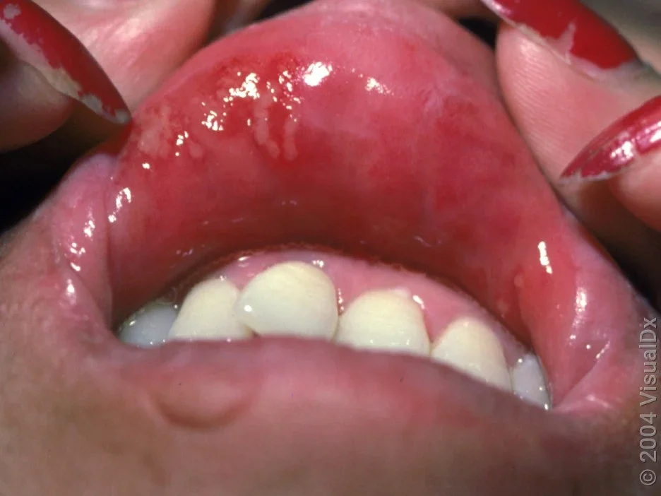 Close-up of canker sores on the upper lip. 